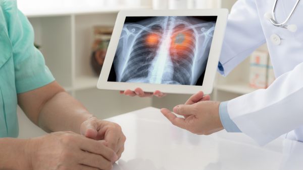 هل يمكن اكتشاف سرطان الرئة من خلال اختبارات الدم ؟