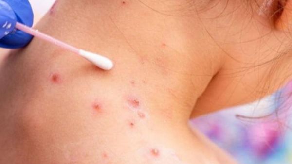  رصد حالة إصابة بمرض جدري القرود لشخص عائد من خارج المملكة