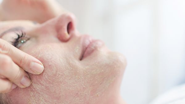 تقشير الوجه..6 علامات تخبرك بأنه حان الوقت لذلك