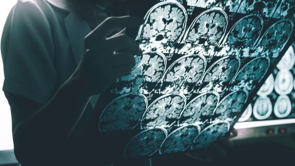 Alzheimer's disease
