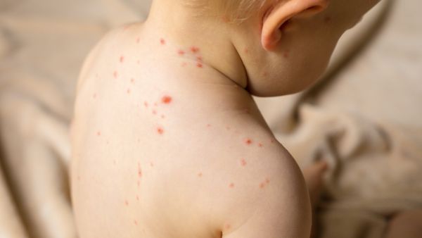 مرض الجدري: أعراضه، مضاعفاته، طرق علاجه