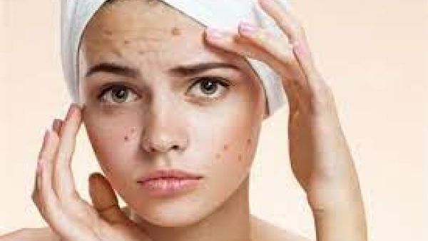 أماكن الحبوب في الوجه على ماذا تدل