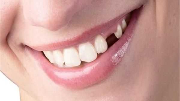 تفسير حلم سقوط الأسنان في المنام للمتزوجة