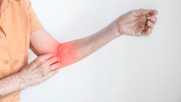 ينتقل مرض الجرب بسهولة عن طريق الاتصال المباشر بجلد الشخص المصاب