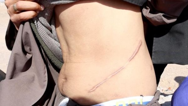 اثار عملية جراحية على شخص قام بالتخلي عن كليته