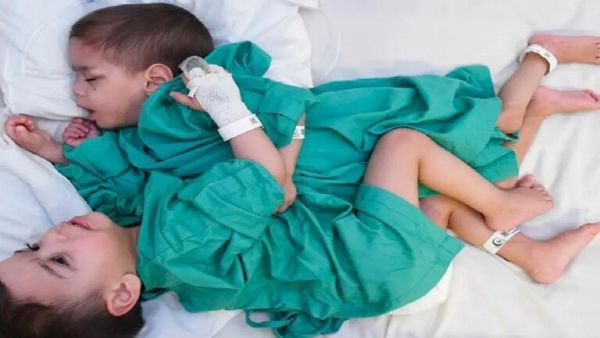 فصل التوأم السيامي السوري "إحسان وبسام" 