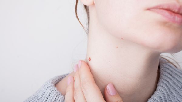 طبيب البوابة: طرق علاج التقرن الدهني (Seborrheic keratosis) 