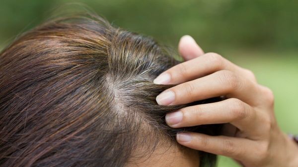 تفسير حلم نزع القمل من الشعر للعزباء وللمتزوجة وللمطلقة بالتفصيل