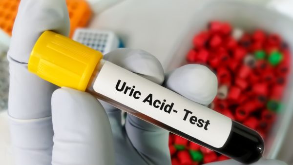 5 علاجات فعالة لخفض مستويات حمض اليوريك