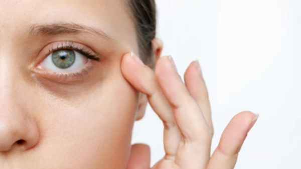 dark circles