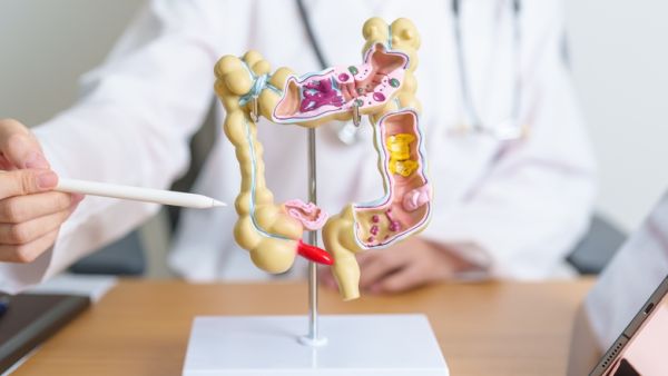 colon cancer