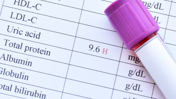 5 علاجات طبيعية لخفض مستويات حمض البوليك 5 علاجات طبيعية لخفض مستويات حمض البوليك