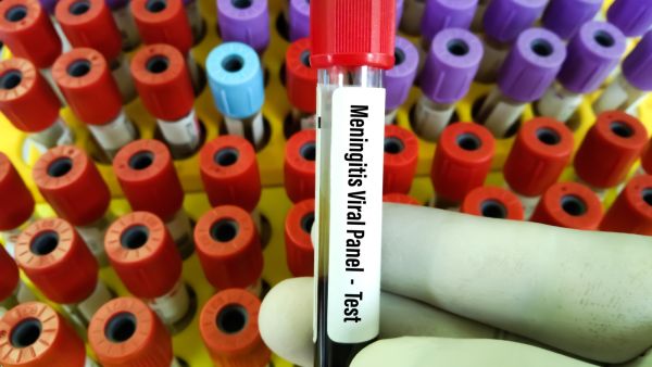 التهاب السحايا: الأعراض، المضاعفات، طرق الوقاية