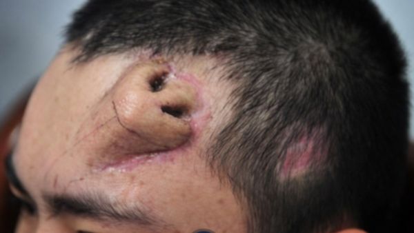  بناء أنف بطريقة مبتكرة