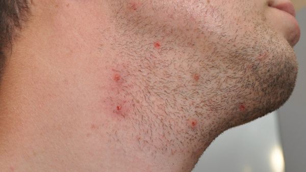 أسباب ظهور الحبوب بعد الحلاقة وطرق التعامل معها