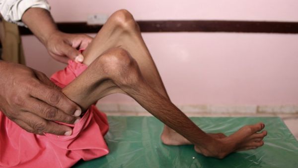 A Yemeni child suffering from malnutrition receives care at a treatment centre in a hospital in Yemen (AFP)