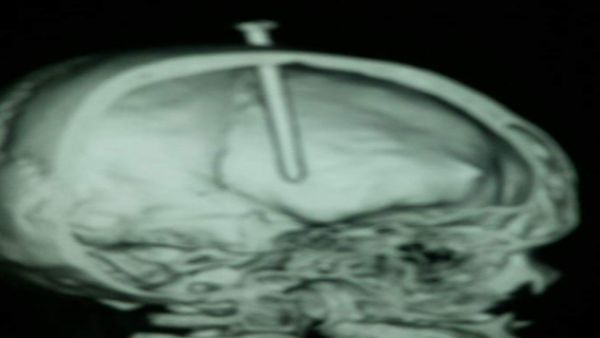 صورة بالاشعة للمسمار في الرأس