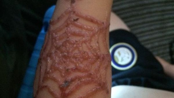 Toni Feeney, of Colne, Lancashire, took to Facebook on Friday cautioning other parents of the dangers of black henna tattoos after her two sons were left with severe chemical burns  (Twitter)