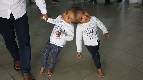 The three-year-old twins will return to Bangladesh after three month to undergo the final operation to separate them (AFP)