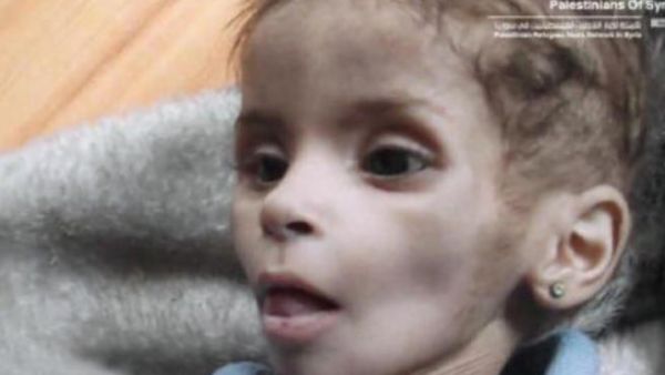 الطفلة آلاء المصري بين الحياة والموت