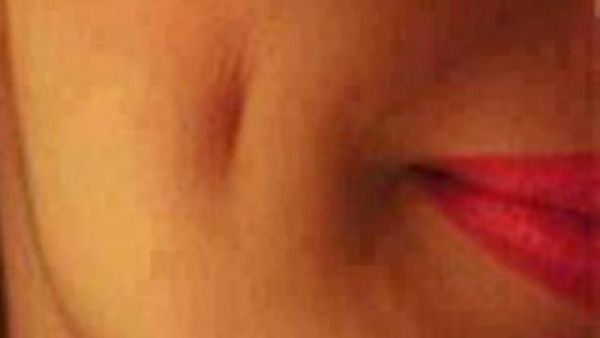 عمليات الغمازات الصناعية تستهوي السعوديات