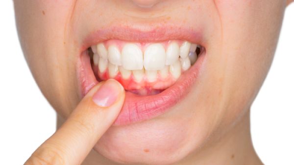 التهابات اللثة قد تساهم في الإصابة بالسرطان 