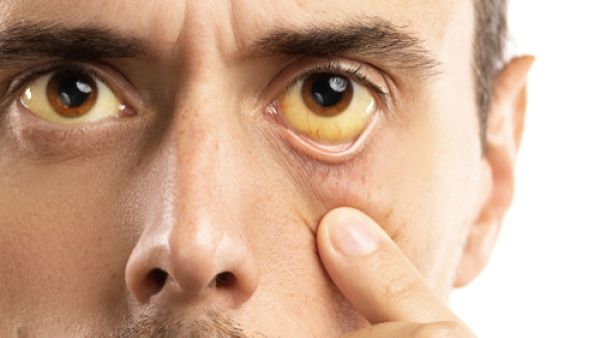 يقلل التهاب الكبد من قدرته على التخلص من البيليروبين مما يؤدي لتراكمه

