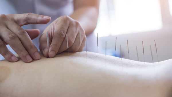 العلاج بالإبر،المستمد من الطب الصيني القديم قد يكون بديلاً لعلاج أعراض الدورة (Shutterstock)