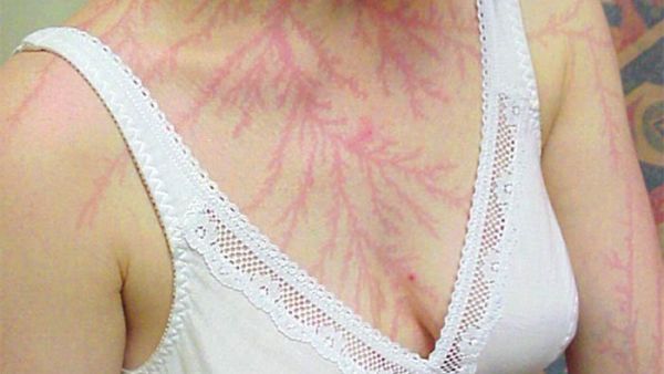 This woman was left with a fern-shaped erythema known as a 'Lichtenberg figure', believed to be the result of a lightning strike on the skin (Twitter)