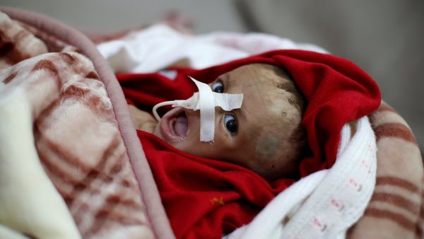 Cholera cases tripled in Hodeidah, Yemen (Twitter)