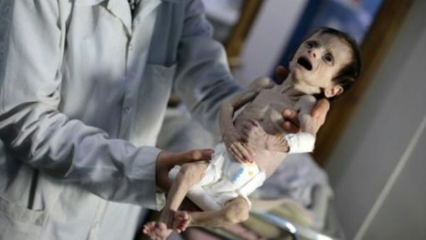 الطفلة سحر التي كانت تعاني من سوء تغذية في عيادة في الحمورية

