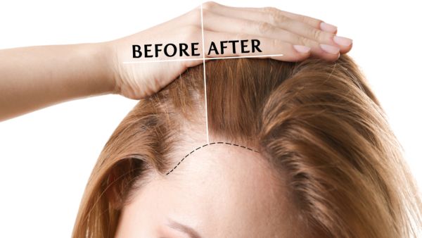 لعمليّة زراعة الشّعر بعض المخاطر كالعمليّات الجراحيّة الأخرى كالنزف والعدوى