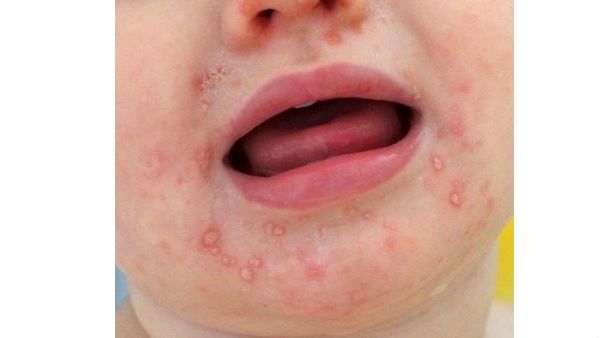 Hand, Mouth, and Foot Disease.