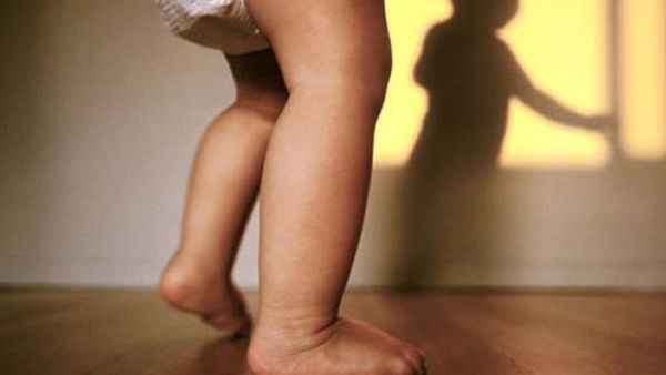 اعوجاج قدم طفلك منذو الولاده. اعوجاج قدم طفلك منذو الولاده.