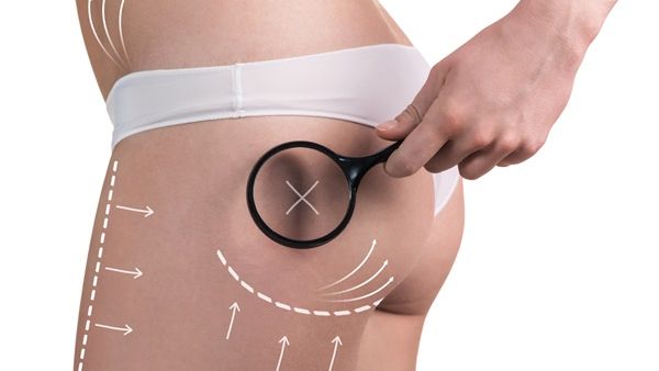 هل ينجح الكونتور في تجميل المؤخرة بشكل دائم؟