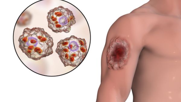 مرض اللشمانيا هو مرض طفيلي المنشأ ينتقل عن طريق قرصة ذبابة الرمل مرض اللشمانيا هو مرض طفيلي المنشأ ينتقل عن طريق قرصة ذبابة الرمل