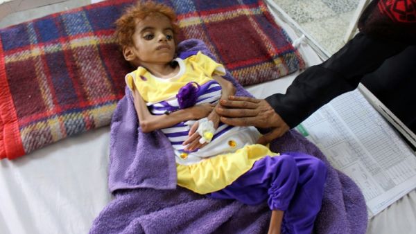 A Yemeni child suffering from malnutrition is measured at a hospital in the Hajjah province, western Yemen. (AFP/File)