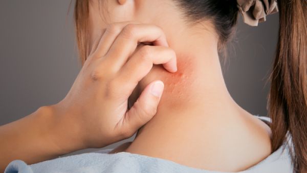 كثيرًا ما نتعرض للدغات أو عضات البعوض خصوصاً في فصل الصيف