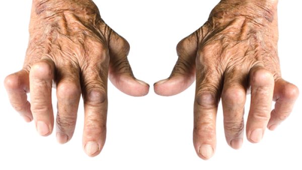 أسباب مرض الرّوماتيزم التدخين والسمنة
