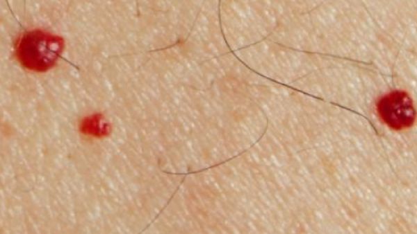 تناول الأدوية التي لها أعراض جانبية كظهور البقع وانتشارها