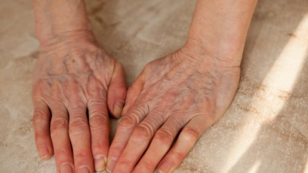 تظهر العروق أو الأوعية الدّموية البارزة عند بعض الأشخاص ويكون سببها خلقي