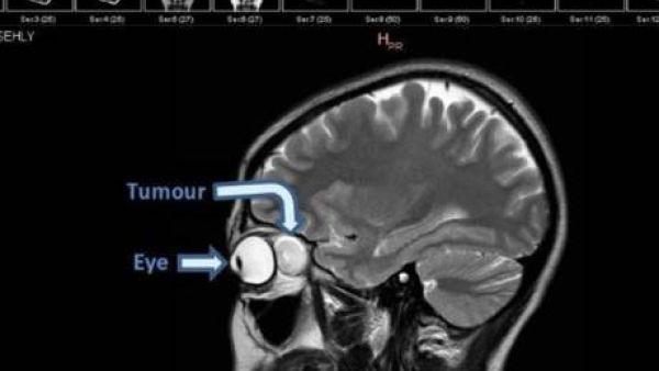 The patient was discharged the following day, with her vision fully restored. (File photo)