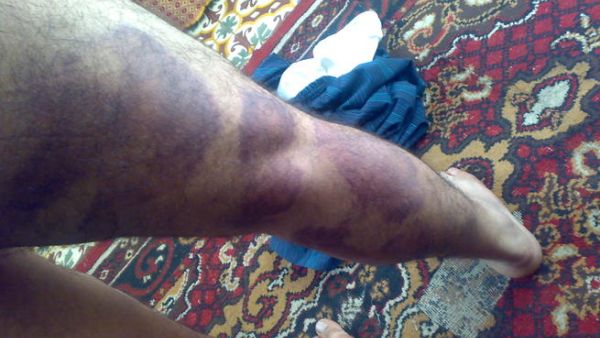 معتقل تعرض للتعذيب في سجن لحماس