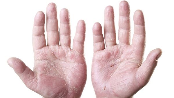 Psoriasis is a chronic, genetic autoimmune disease that causes red, scaly patches on the skin. Psoriasis is a chronic, genetic autoimmune disease that causes red, scaly patches on the skin.