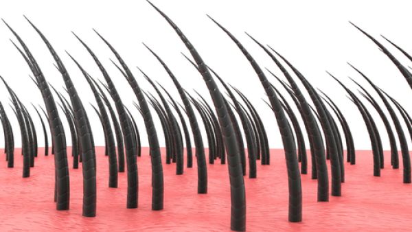 الشعر تحت الجلد مشكلةٌ تظهر عندما ينمو الشعر بشكل ملتوٍ تحت الجلد

