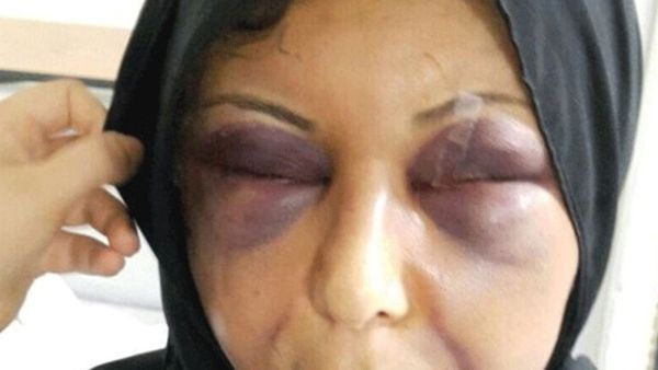 آثار التعنيف على السيدة زهراء صبحي تغني عن أي تعليق