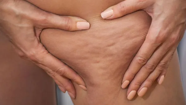 السيلوليت هو عبارة عن تجمع الدهون واحتقان الماء تحت خلايا البشرة 
