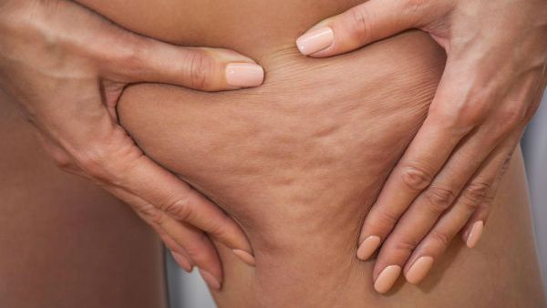 السيلوليت هو عبارة عن تجمع الدهون واحتقان الماء تحت خلايا البشرة 