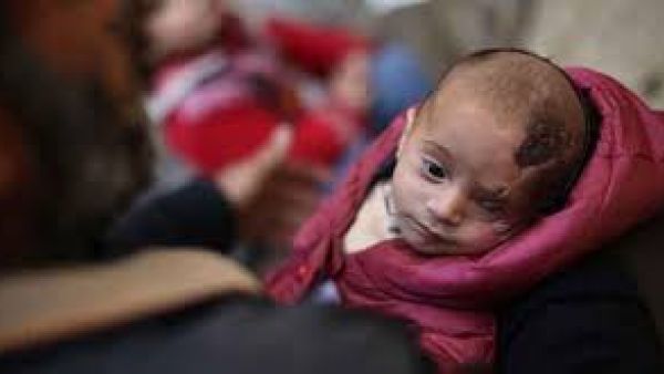 A symbol of resistance to Syria’s Assad regime, “Baby Karim”, who lost one eye to a regime airstrike (AFP/File Photo)

