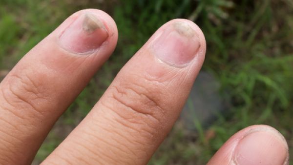 الفطريات حين تصيب الأظافر لا تذهب من تلقاء لابد من المعالجة